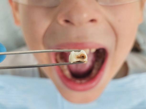 Best Emergency Gum Treatment in Cross Lanes, WV